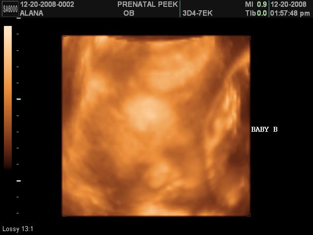 3d ultrasound pictures of twins. 3d Ultrasound of my Twins (29