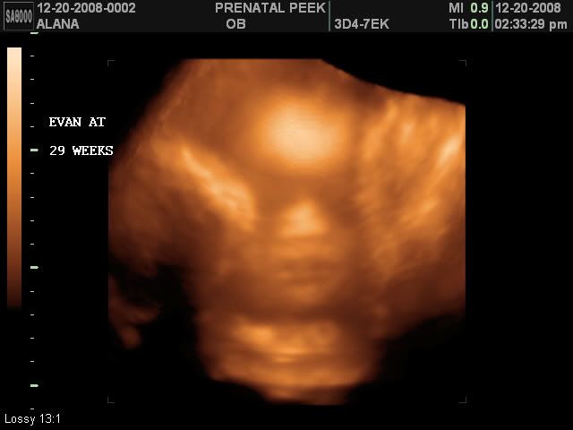 3d ultrasound pictures of twins. 3d Ultrasound Twins
