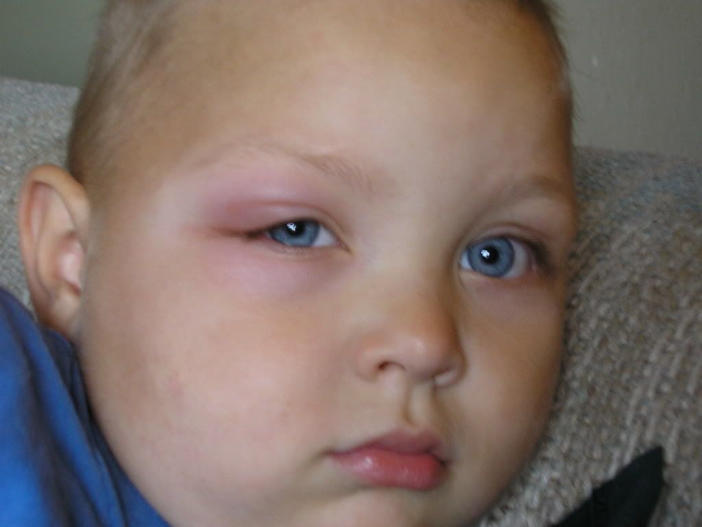 Please help, my son's eye is totally swollen! Mothering Forums
