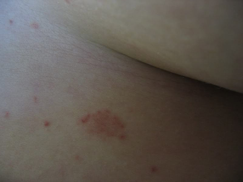 Rash, could it be a Crohn's rash? *pictures* Crohn's Disease Forum