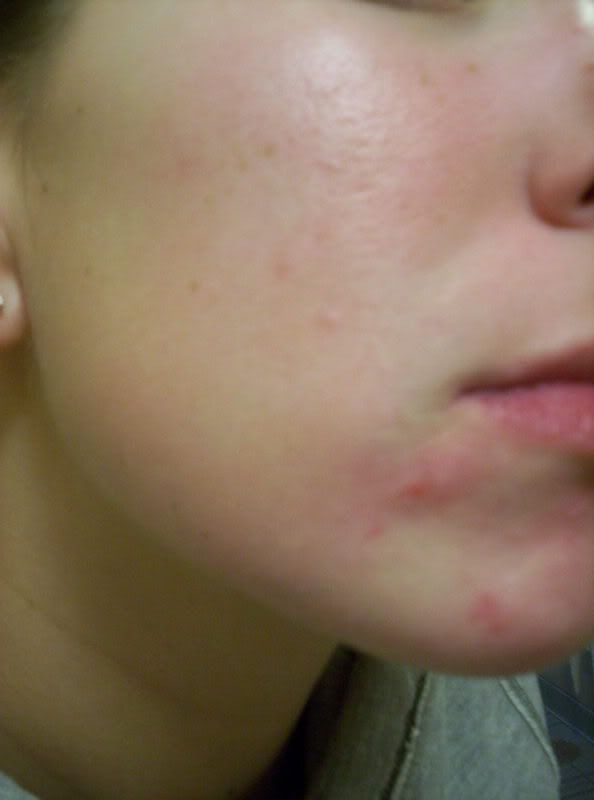 Pay does accutane for insurance health